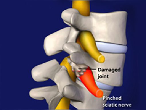 awake spinal fusion