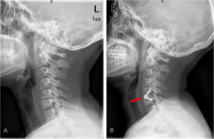 Understanding Anterior Cervical Discectomy and Fusion (ACDF): A Comprehensive Guide