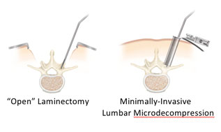 What is a Minimally Invasive Laminectomy / Discectomy?