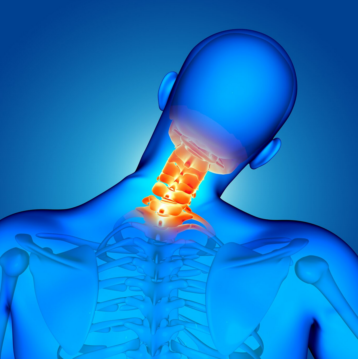 Anterior Cervical Decompression and Fusion Anterior Cervical Decompression and Fusion