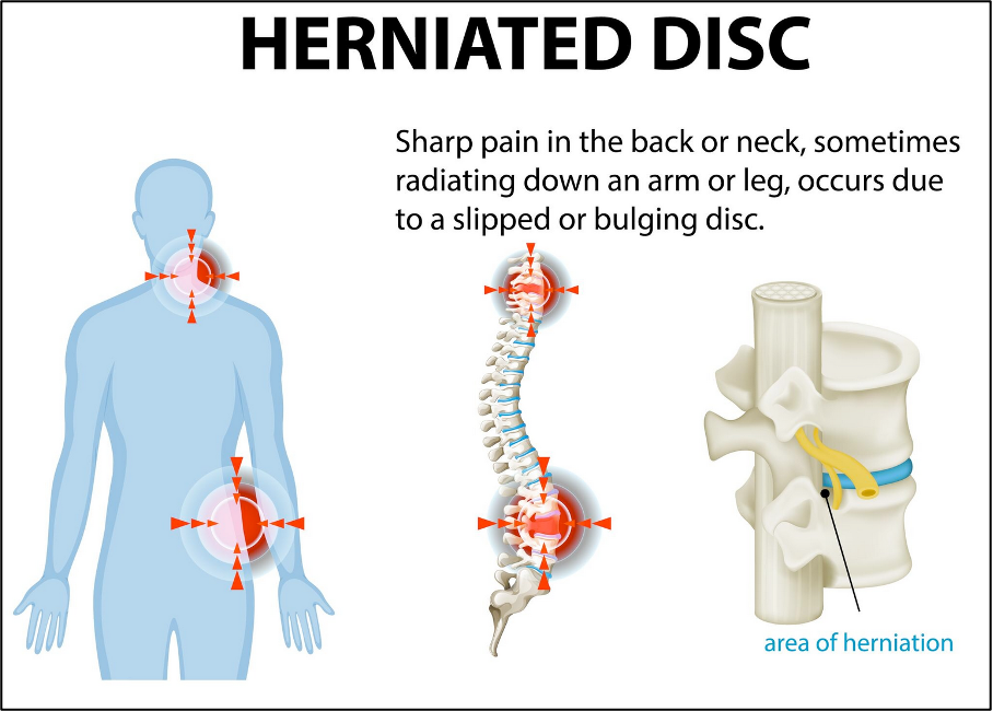 Severe Disc Herniation
