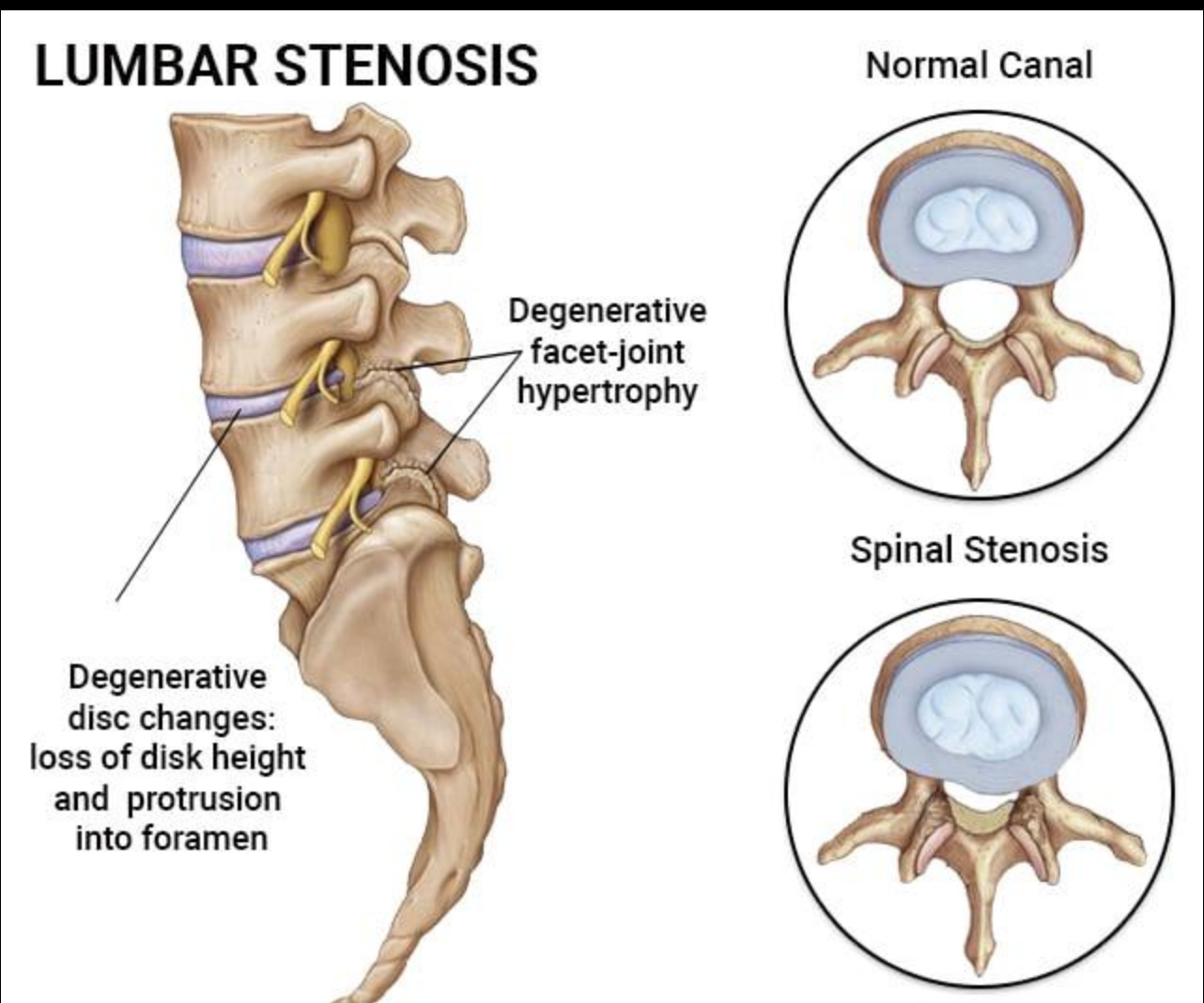 Can Exercise Make Lumbar Spinal Stenosis Worse? Movements to Avoid