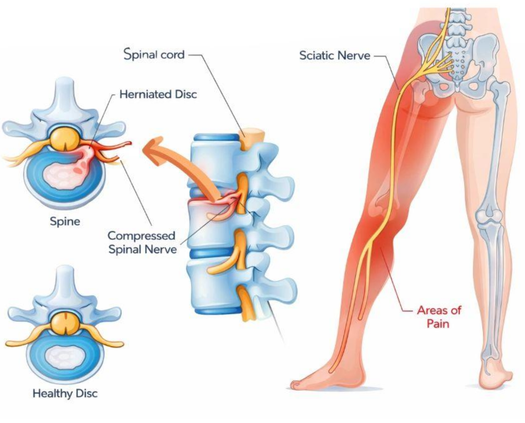 Lumbar Herniated Disc